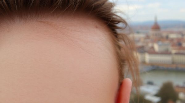 Calvitie à Lyon : Découvrez les meilleures options d'implants